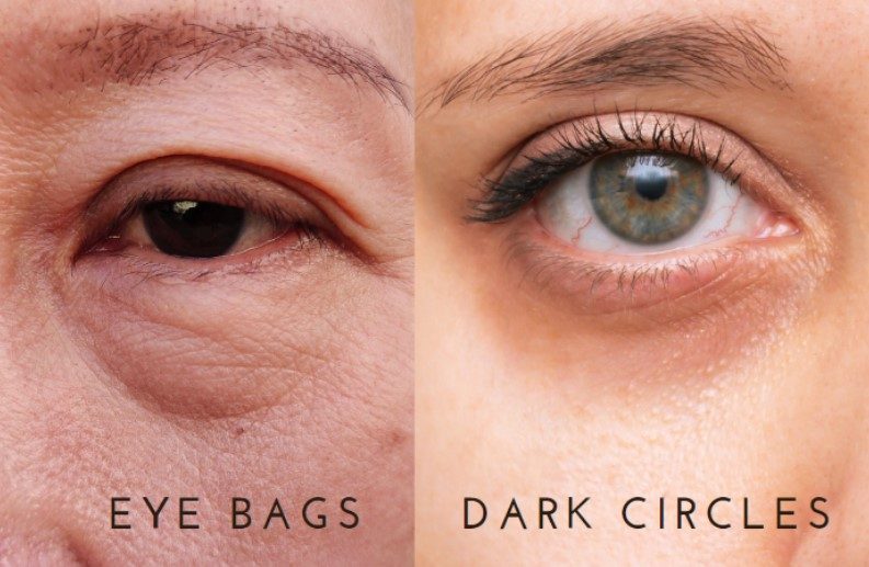 eye bags vs dark circles