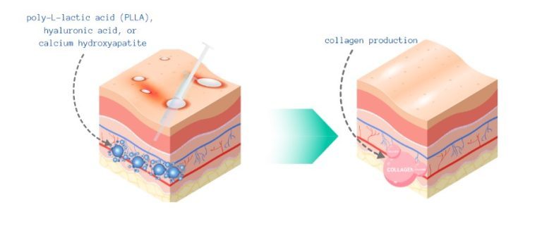 Collagen Biostimulators