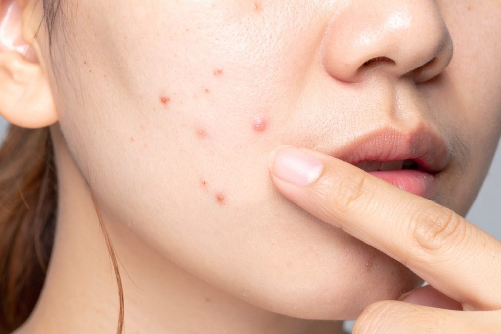 Acne Scars vs Post-Acne Marks