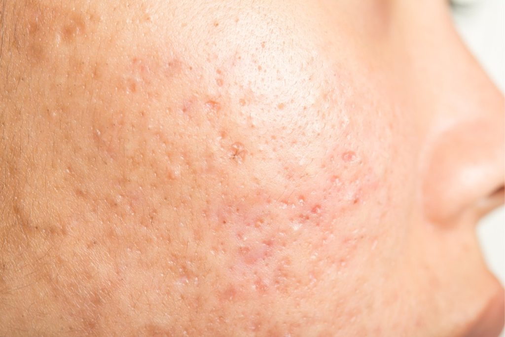 Acne Scars vs Post-Acne Marks