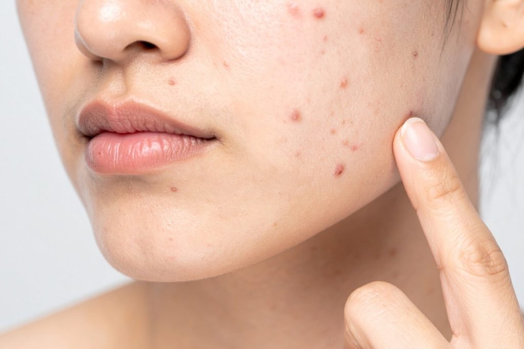 Acne Scars vs Post-Acne Marks