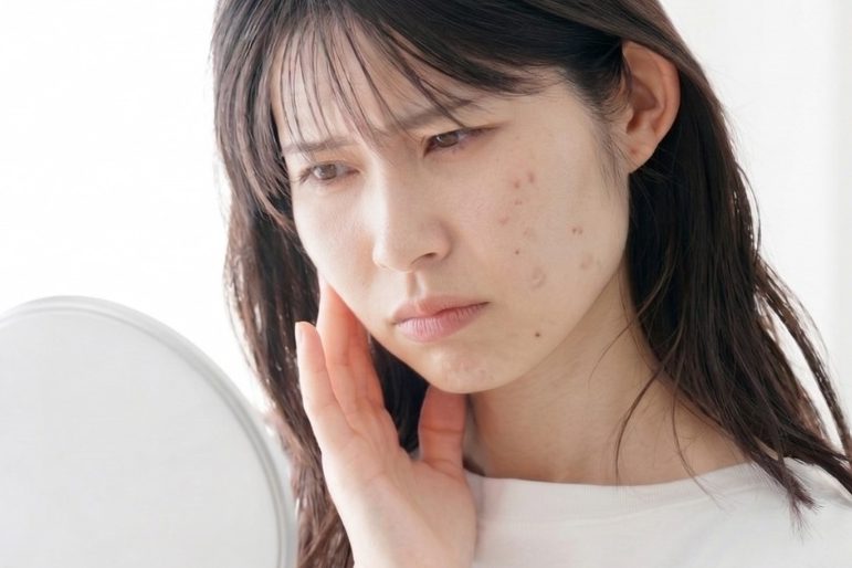 Acne Scars vs Post-Acne Marks